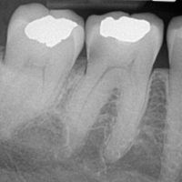 dental x-rays in Asheville, NC