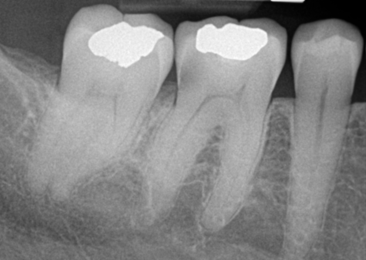 dental x-rays in Asheville, NC